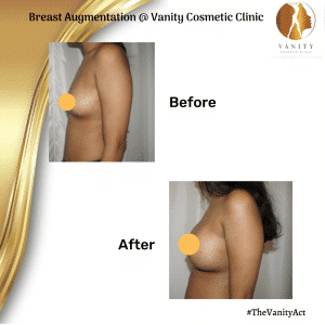 VCC Breast Lift Before After