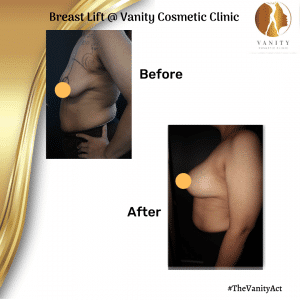 VCC Breast Lift Before After