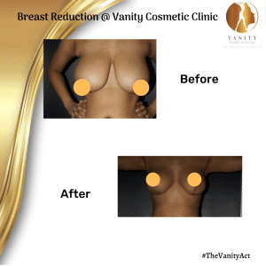 VCC Breast Reduction Before After