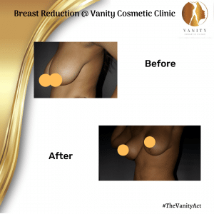 VCC Breast Reduction Before After