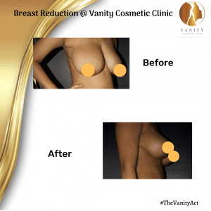 VCC Breast Reduction Before After