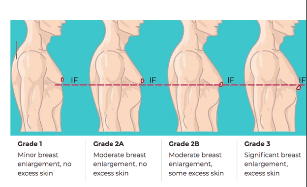 Gynecomastia Stages