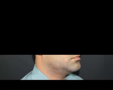 Chin Implant