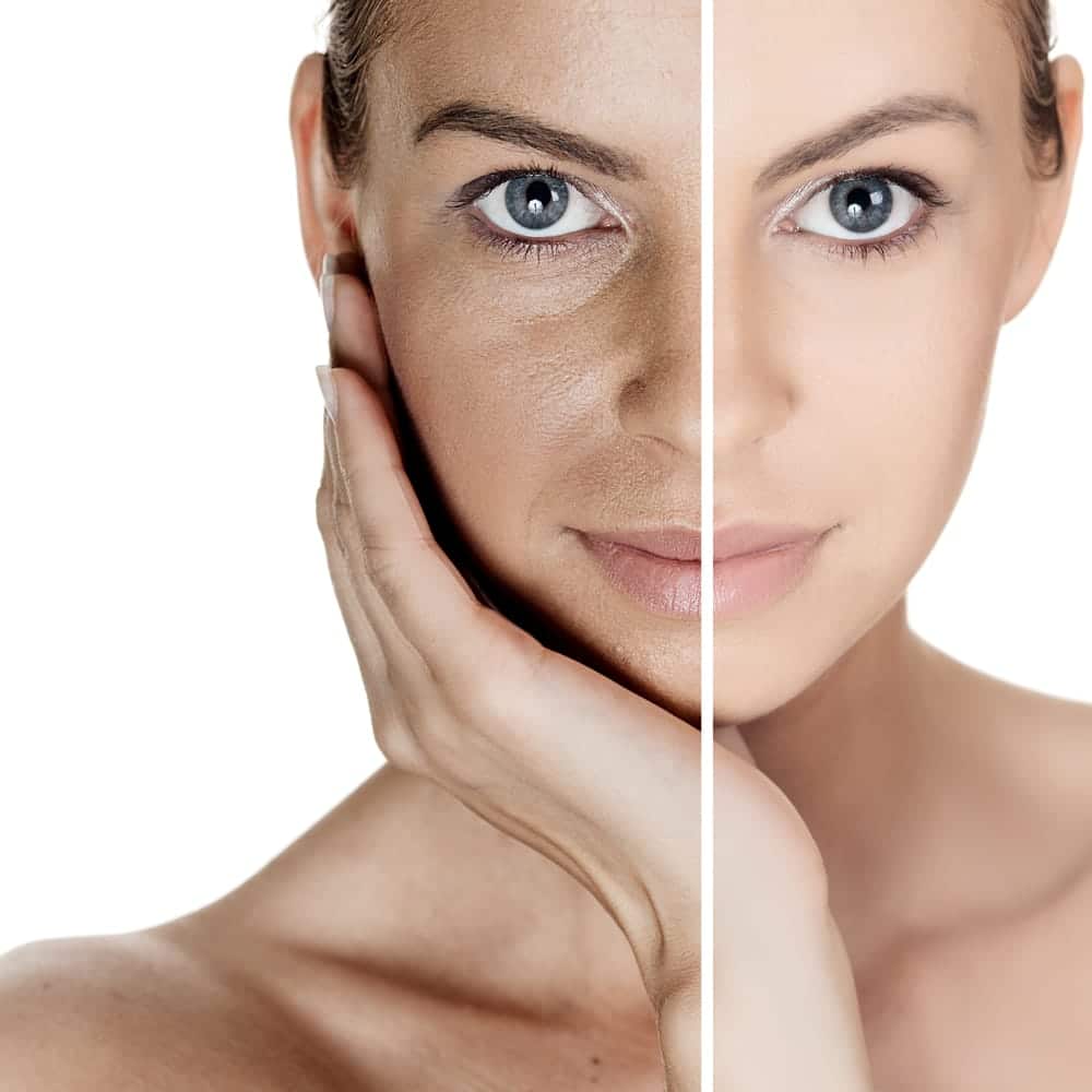 Read more about the article Pigmentation