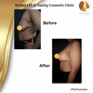 VCC-Breast-Lift-Before-After-Set-3