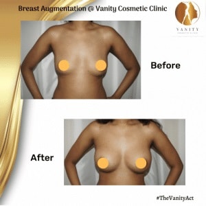 Breast-Augmentation-Surgery-Before-After-set-one