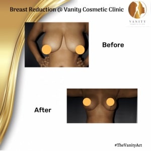 Breast-Reduction-Before-After-Set-One