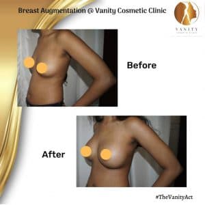 Breast Augmentation Before After