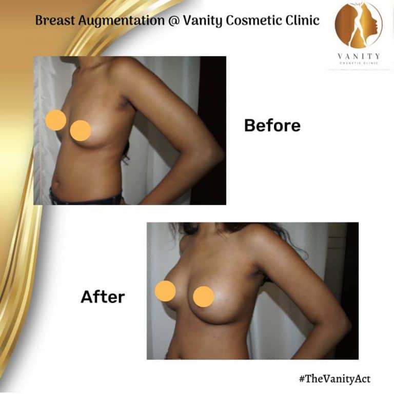 Breast Augmentation Before After