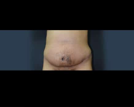 tummy tuck after set one