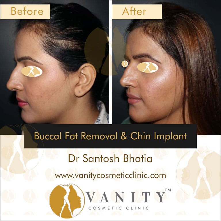 Buccal-Fat-Removal-and-Chin-Implant-45-deg-left-side-view