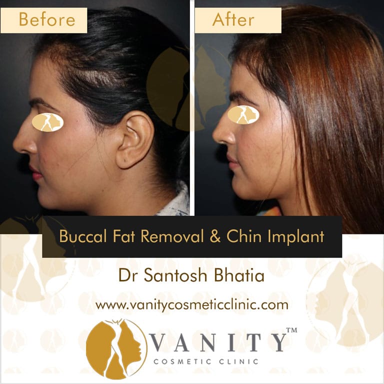 Buccal-Fat-Removal-and-Chin-Implant-left-side-view