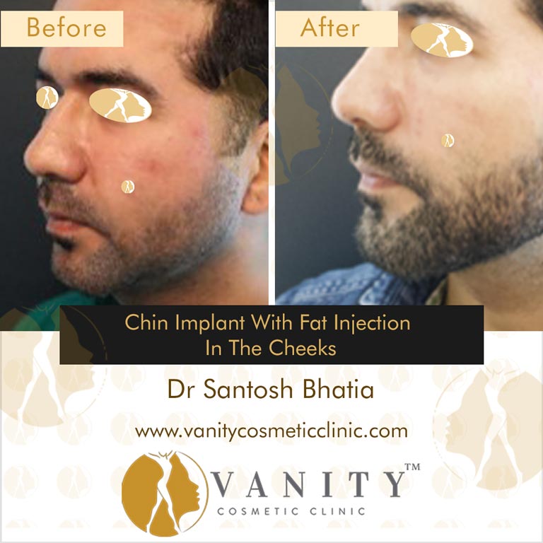Chin-Implant-with-fat-injection-in-the-cheeks-45-deg-left-side-view