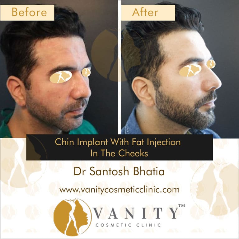 Chin-Implant-with-fat-injection-in-the-cheeks-45-deg-right-side-view