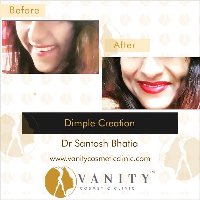 Dimple Creation A Procedure To Get Natural Looking Dimples