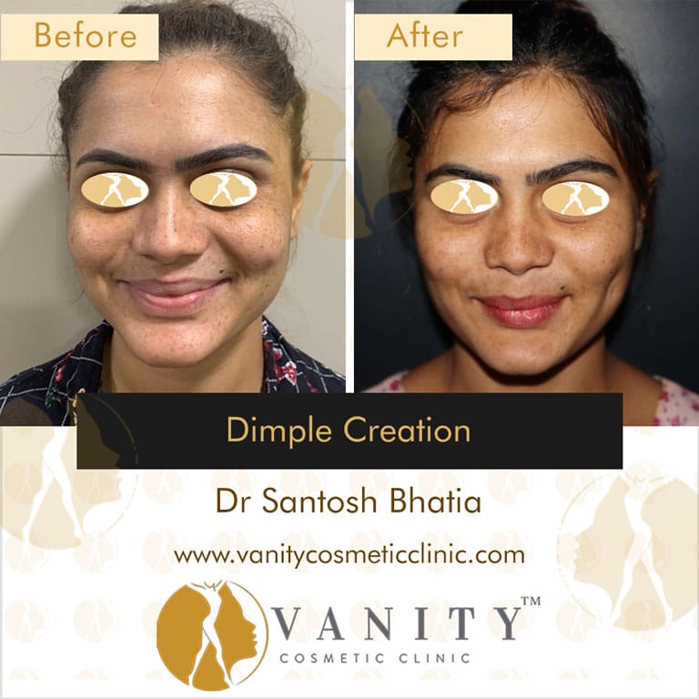 Dimple Creation A Procedure To Get Natural Looking Dimples