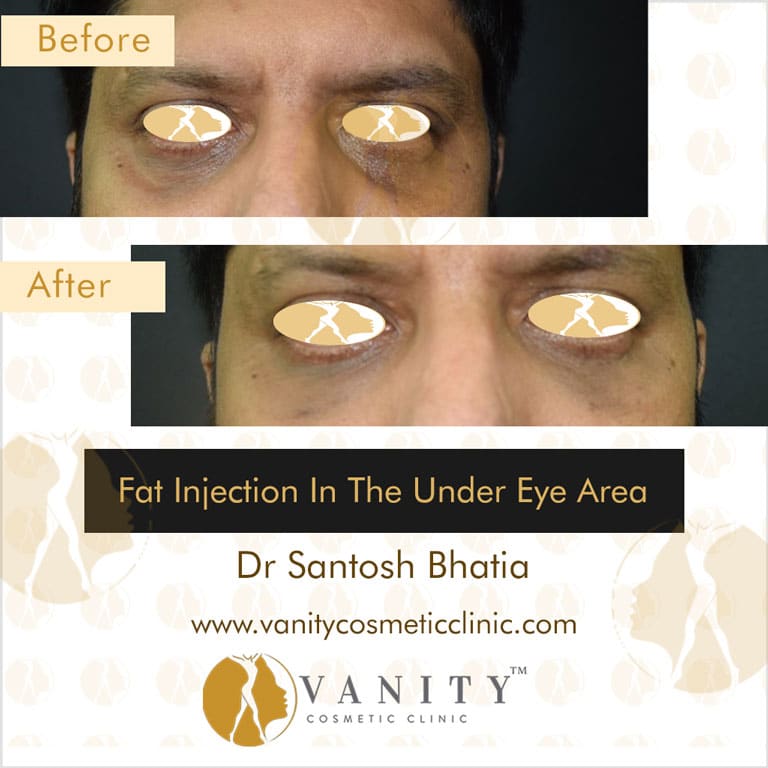 Fat-injection-in-the-under-eye-area-front-view