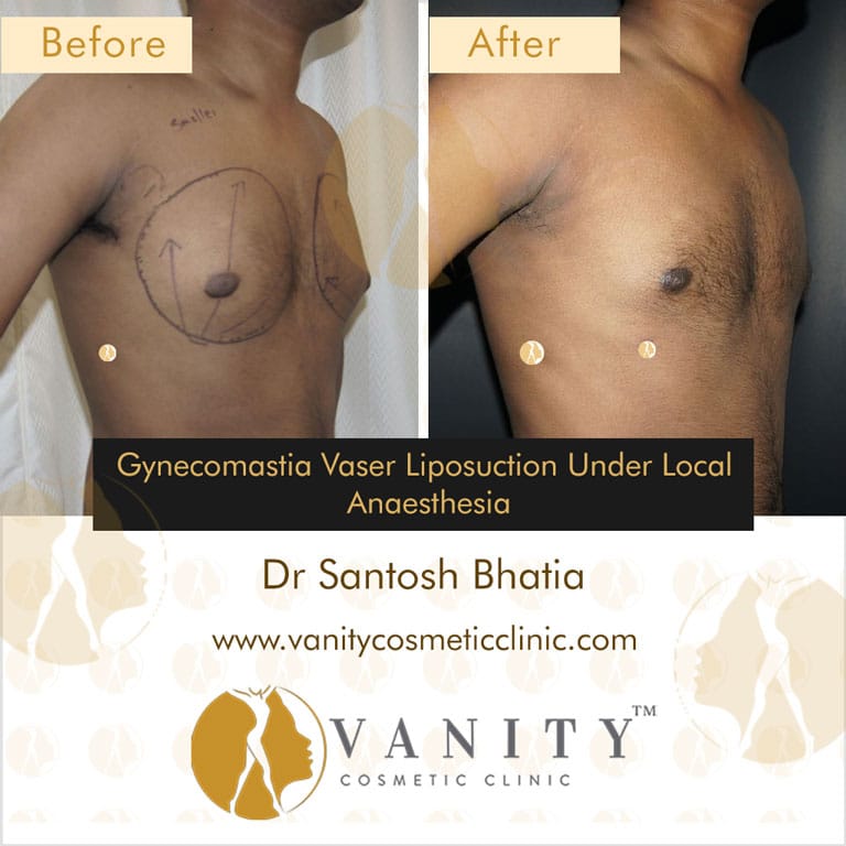 Gynecomastia with Vaser Liposuction