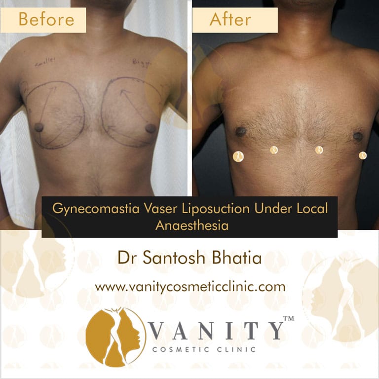 Gynecomastia-Vaser-Liposuction-under-local-anaesthesia-front-view-case-5