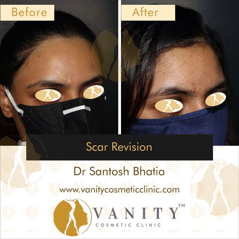 Scar-Revision-45-deg-right-side-view-2