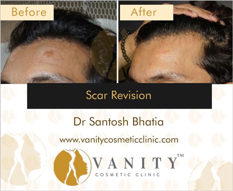 Scar-Revision-front-view-1