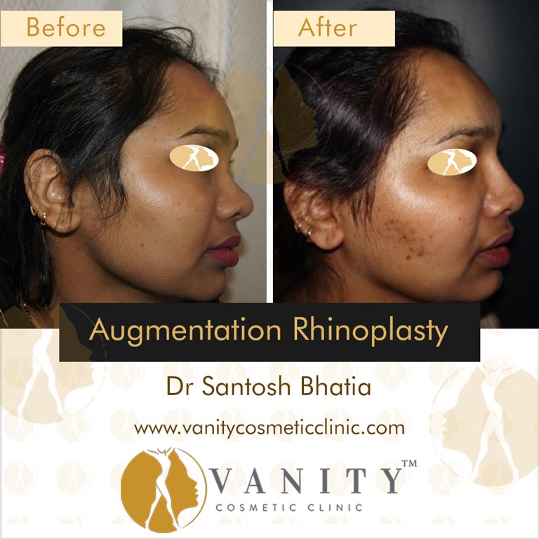 augmentation-rhinoplasty-right-side-view