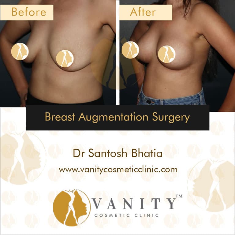 Breast Augmentation In Mumbai