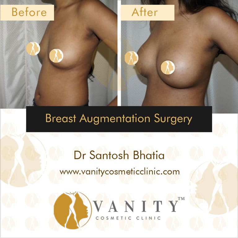 Case 3 : Breast Augmentation Surgery 45 Degree Right Side View