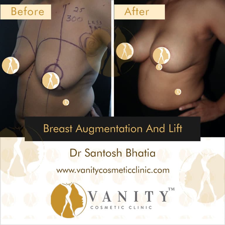 Case 4 : Breast Augmentation And Lift 45 Degree Right Side View
