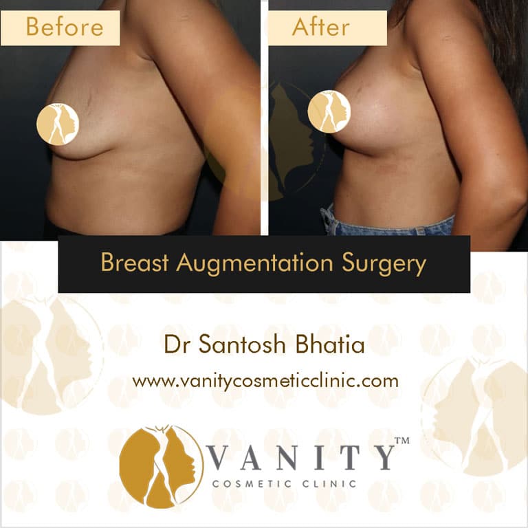 Case 1 : Breast Augmentation Surgery Right Side View