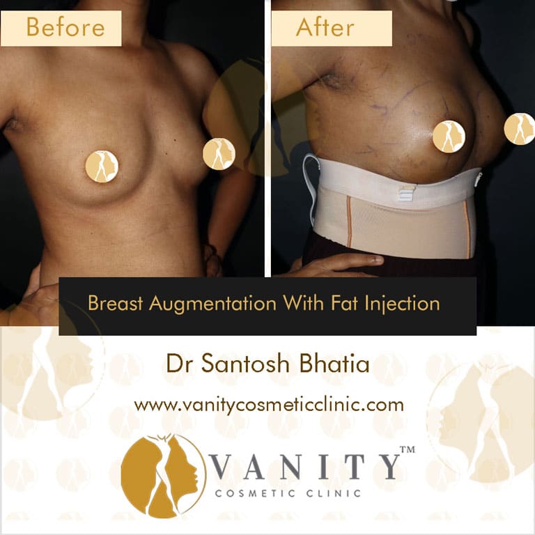 https://www.vanitycosmeticclinic.com/wp-content/uploads/2021/08/breast-augmentation-with-fat-injection-45-deg-left-side-view-case-2.jpg