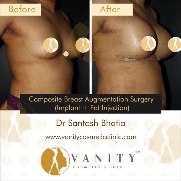 Case 6 : : Breast Augmentation With Implants And Fat Injection 45 Degree Left Side View