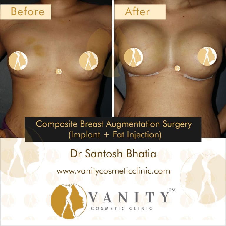 Breast Augmentation In Mumbai