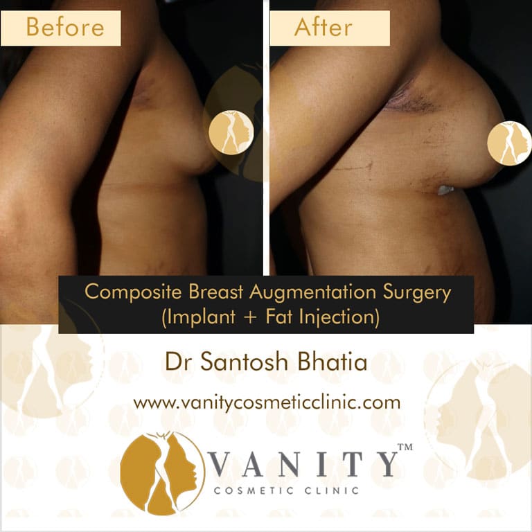 Case 6 : Breast Augmentation With Implants And Fat Injection Left Side View