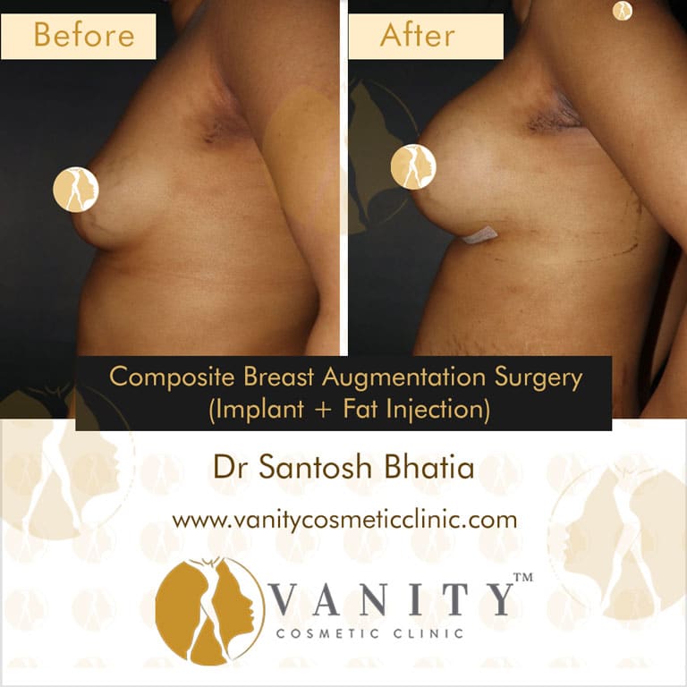 Case 6 : Breast Augmentation With Implants And Fat Injection Right Side View