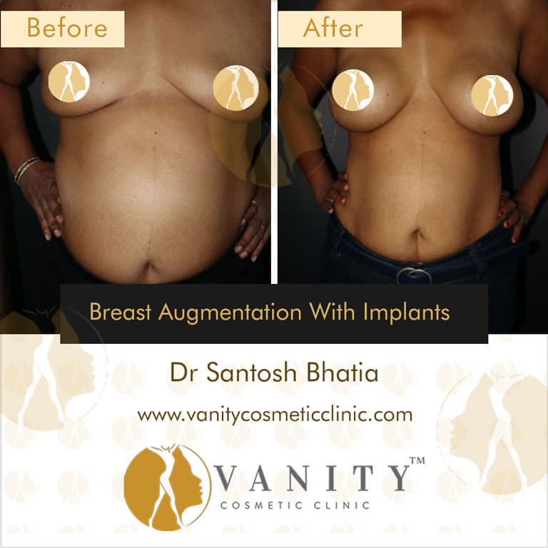 Case 5 : Breast Augmentation with implants Front View