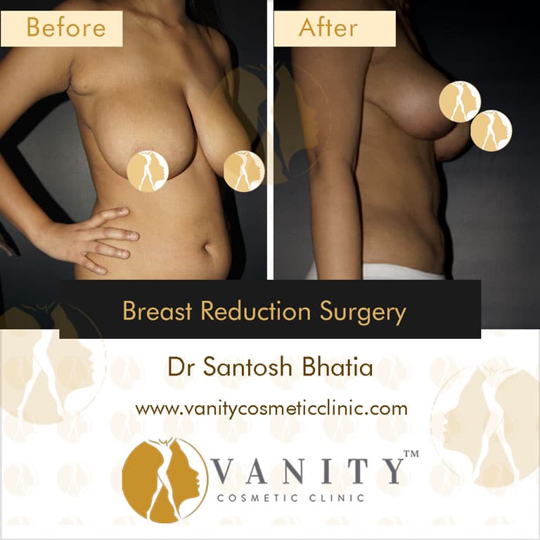 Case 1 : Breast Reduction Surgery 45 Degree Left Side View