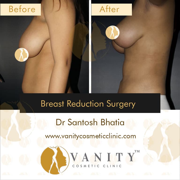 Case 1 : Breast Reduction Surgery Right Side View