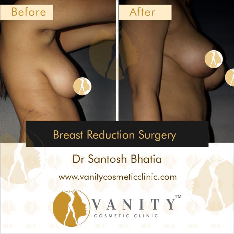 breast-reduction-right-side-view-2-case-3_1