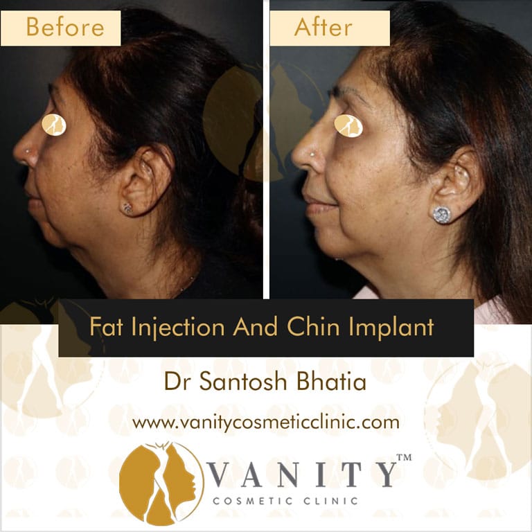 Before & After Pictures of Clients - Vanity Cosmetic Clinic