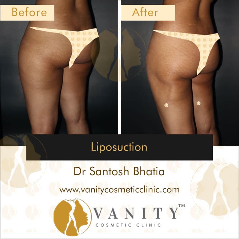 Liposuction 45 Degree Left Side View (Back)