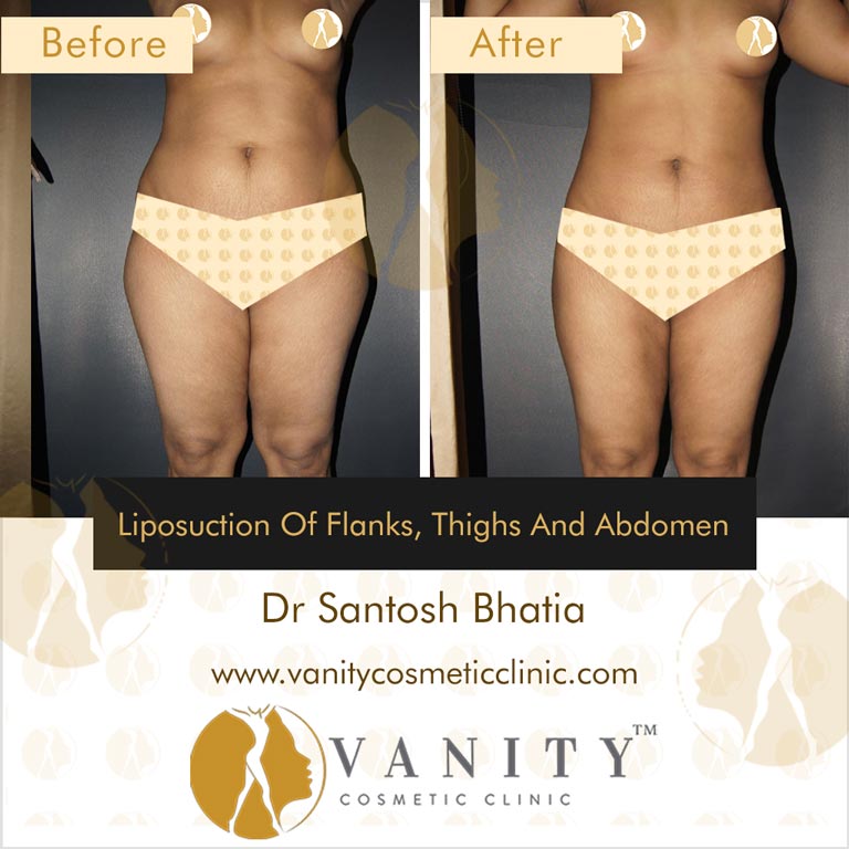 What are the flanks, and why is it so hard to get rid of fat there? -  Cosmetic Enhancement Center of New England