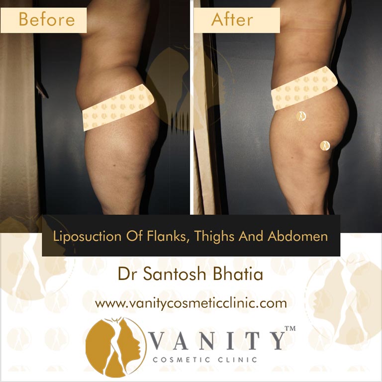 Upper and Lower Abdomen and Flank Liposuction, Inner and Outer Thigh  Liposuction with Fat Transfer to Buttocks - Terrell Clinic