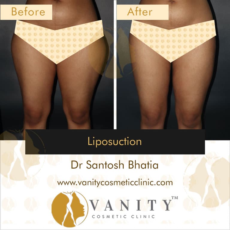 Liposuction Front View