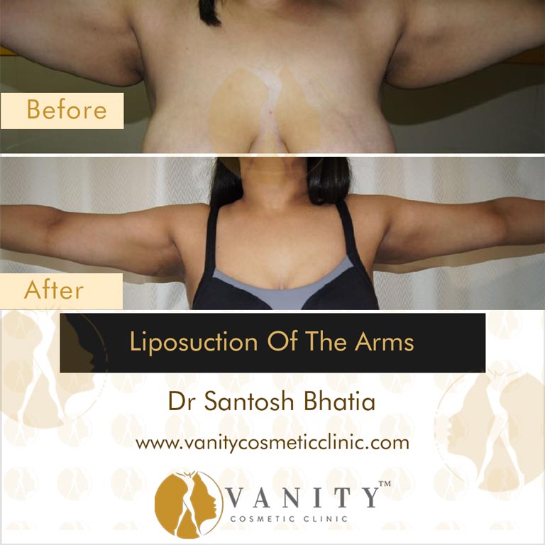 liposuction-of-arms-front-view