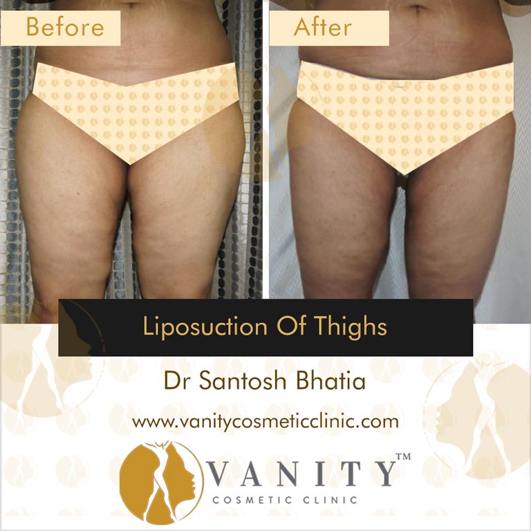 Liposuction of thighs Front View