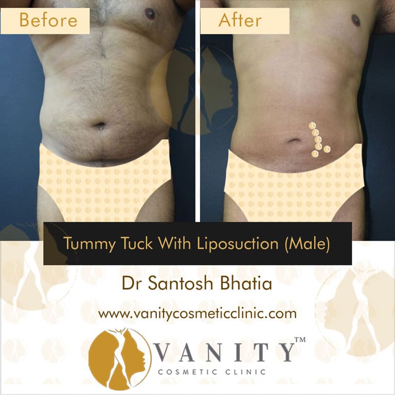 male-tummy-tuck-with-liposuction-front-view-1
