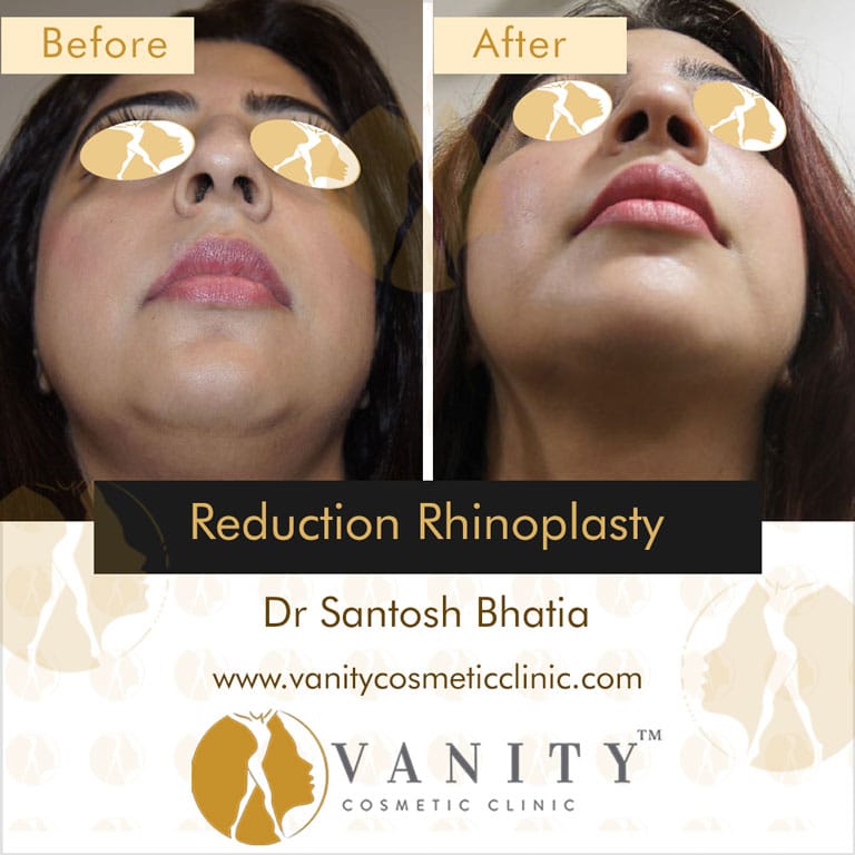 reduction-rhinoplasty-bottom-view-1