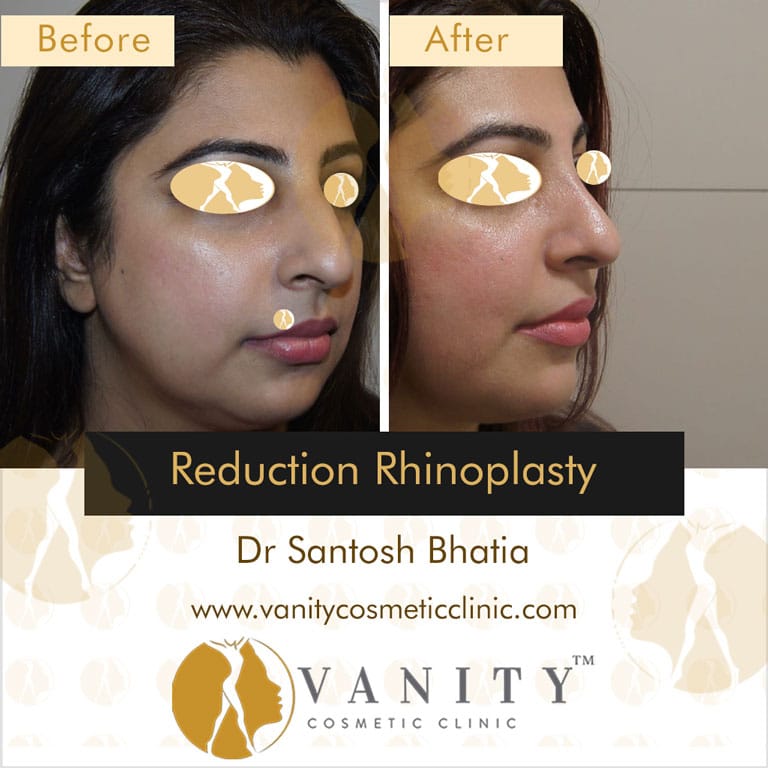 reduction-rhinoplasty-right-side-view-1