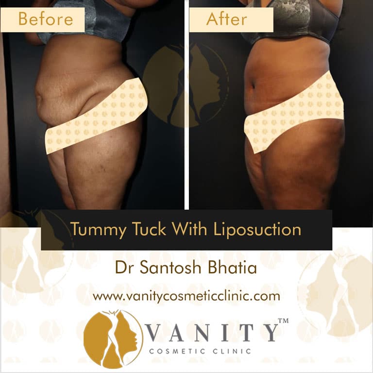 tummy-tuck-with-liposuction-45-deg-left-side-view-1_3
